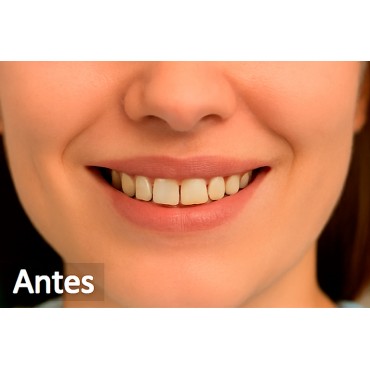 7. Antes