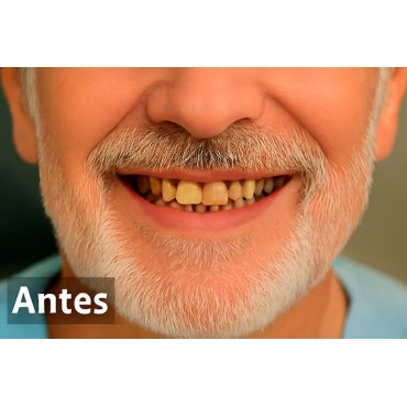 5. Antes