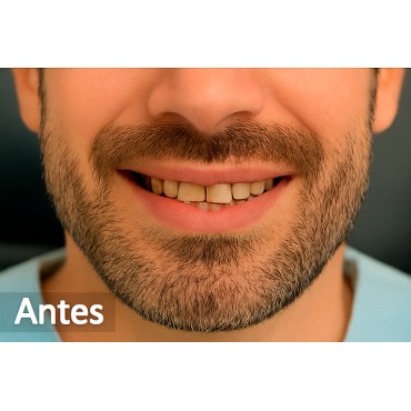 9. Antes