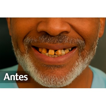 1. Antes